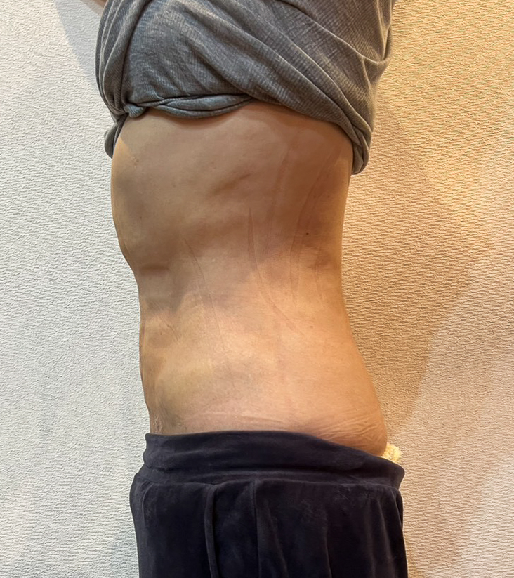 お腹の脂肪吸引