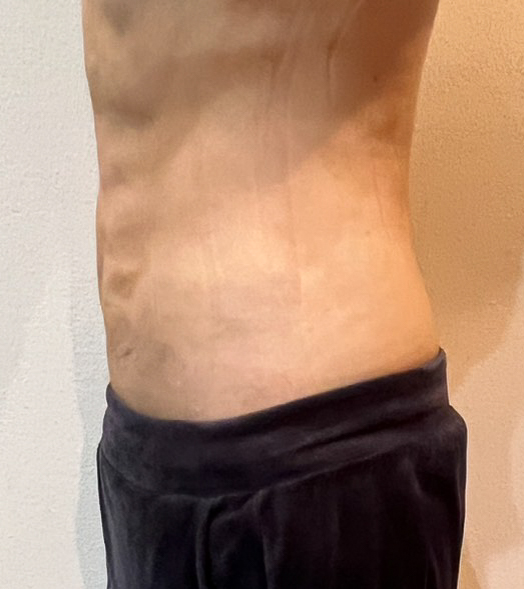 お腹の脂肪吸引