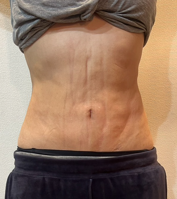 お腹の脂肪吸引