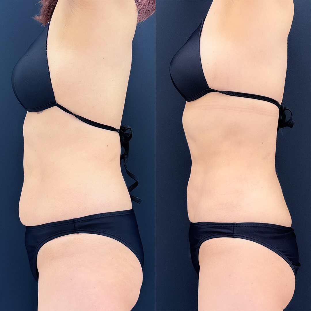 https://purelys-tokyo-clinic.com/wp/wp-content/uploads/2026/05/Before-and-After-abdominal-Liposuction_Case-No.490.jpg