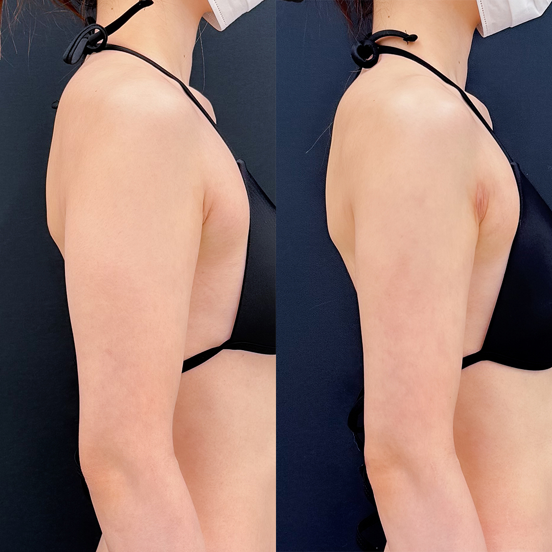 https://purelys-tokyo-clinic.com/wp/wp-content/uploads/2026/05/arm-Liposuction_Case-No.631.jpg