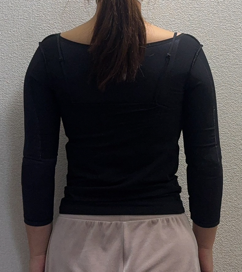 二の腕の脂肪吸引