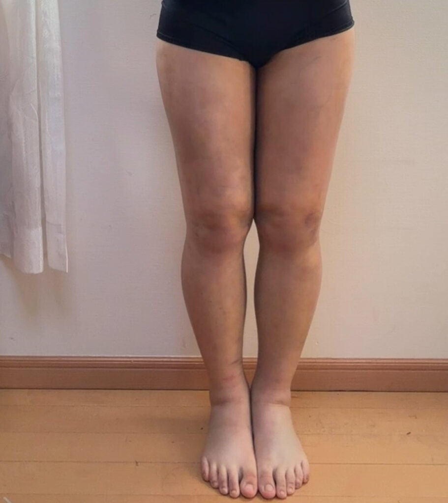 脂肪豊胸