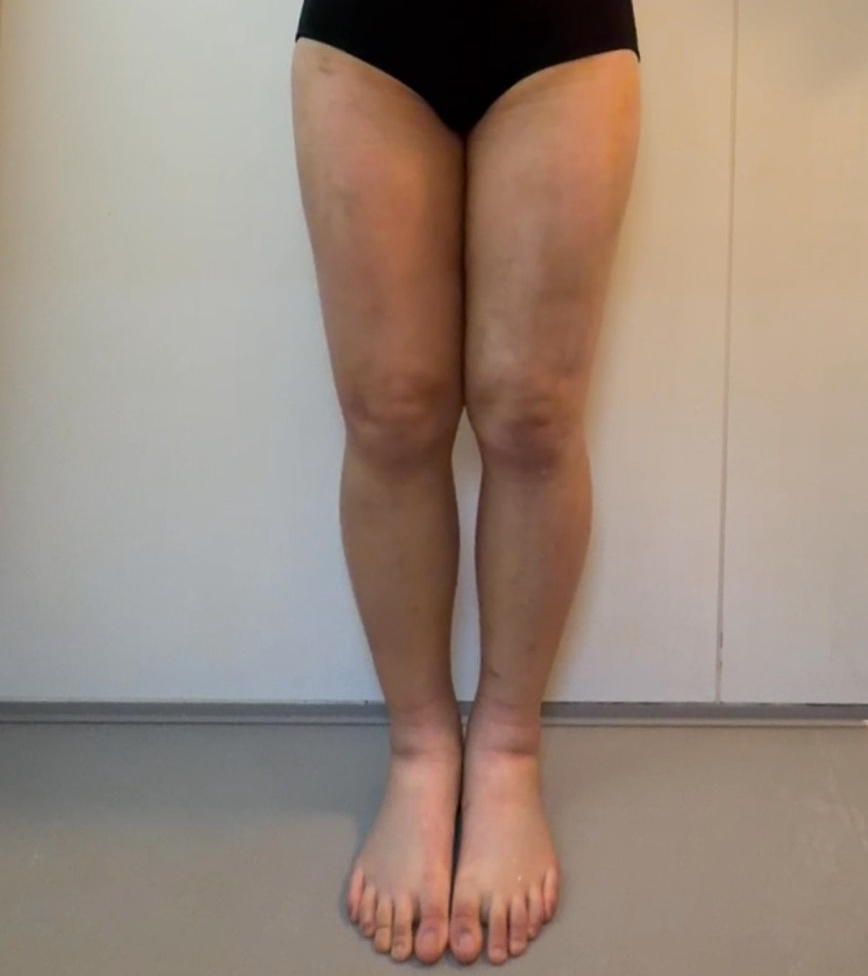 脂肪豊胸