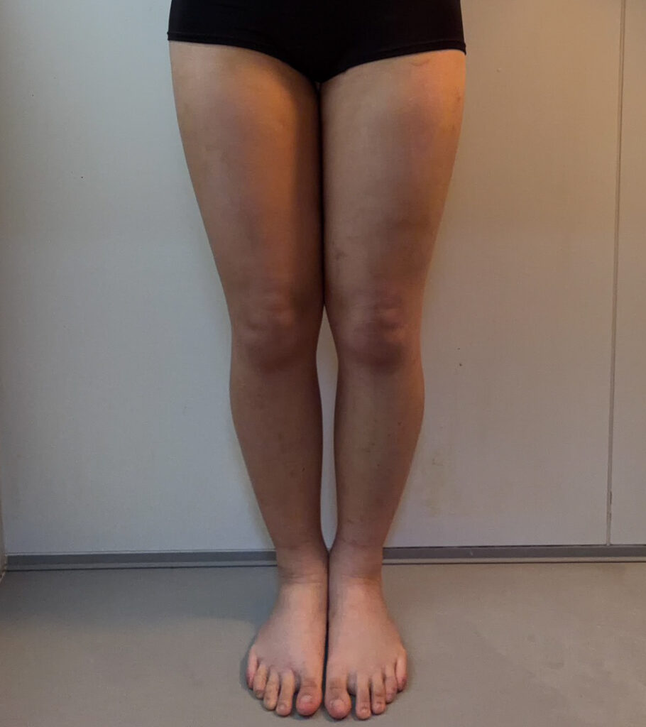 脂肪豊胸