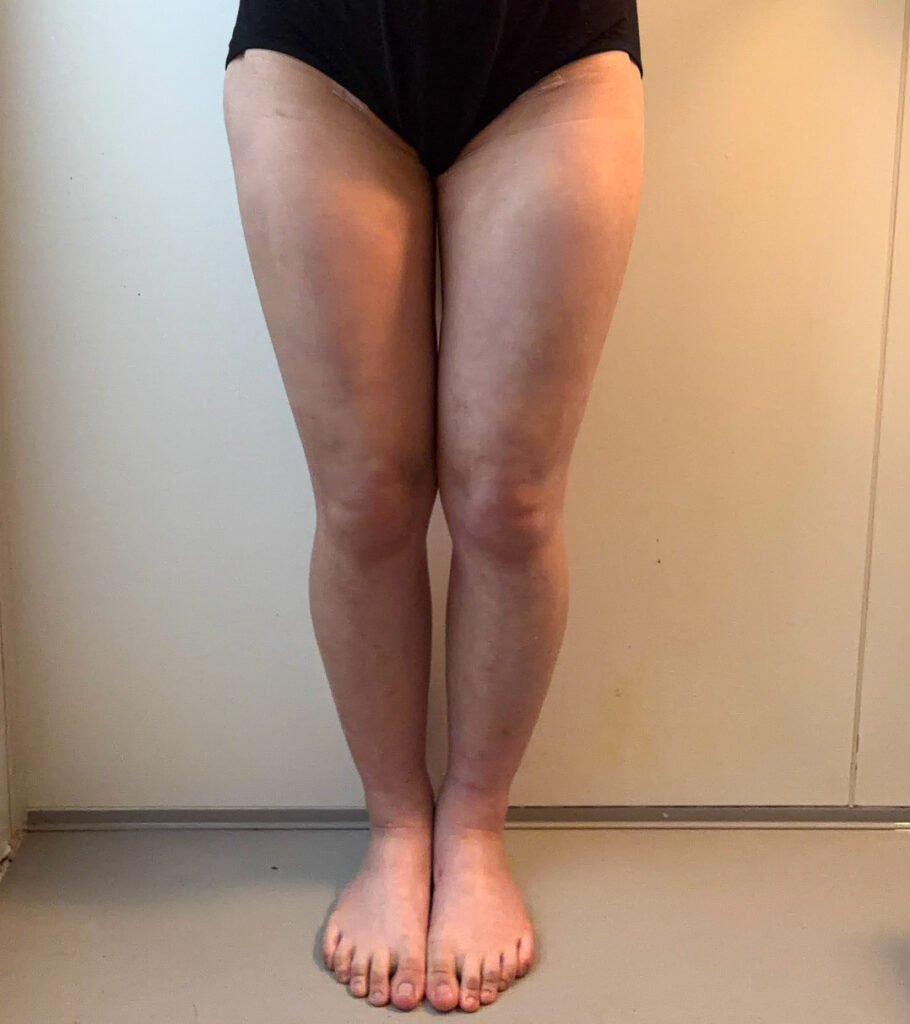 脂肪豊胸