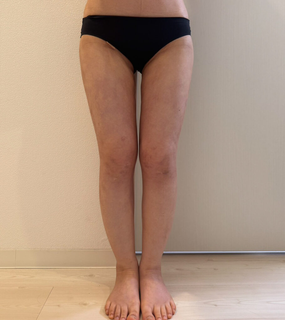 脂肪豊胸