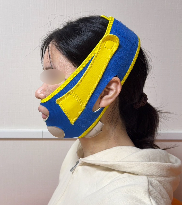顔の脂肪吸引