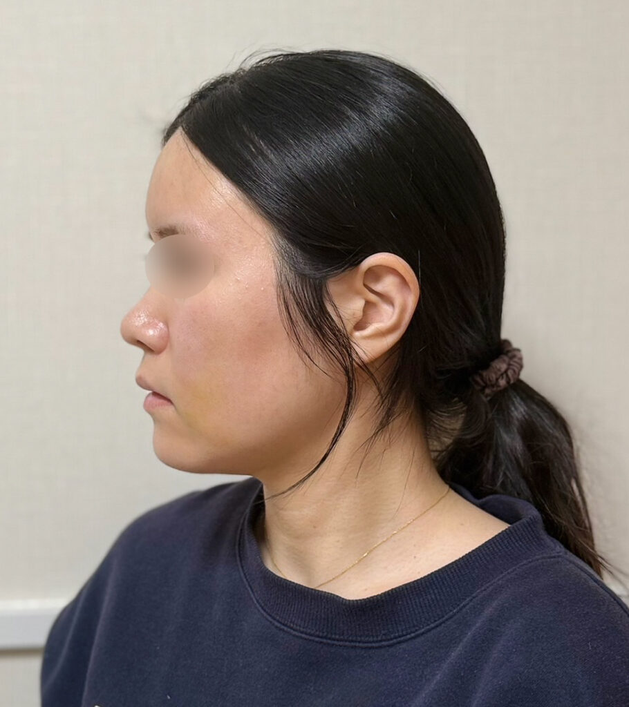 顔の脂肪吸引