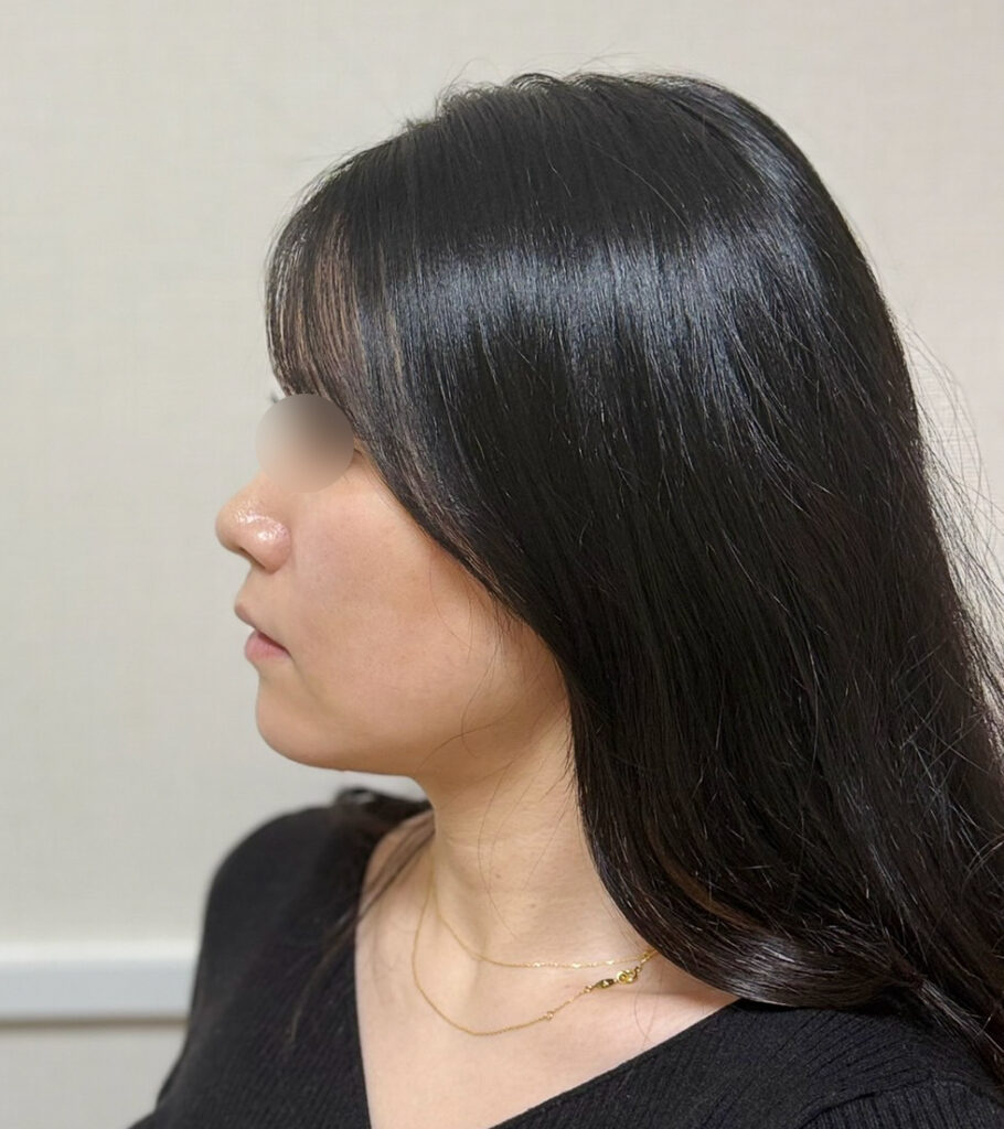 顔の脂肪吸引