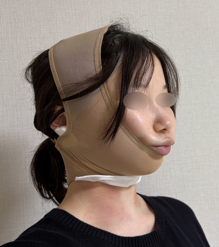 顔の脂肪吸引