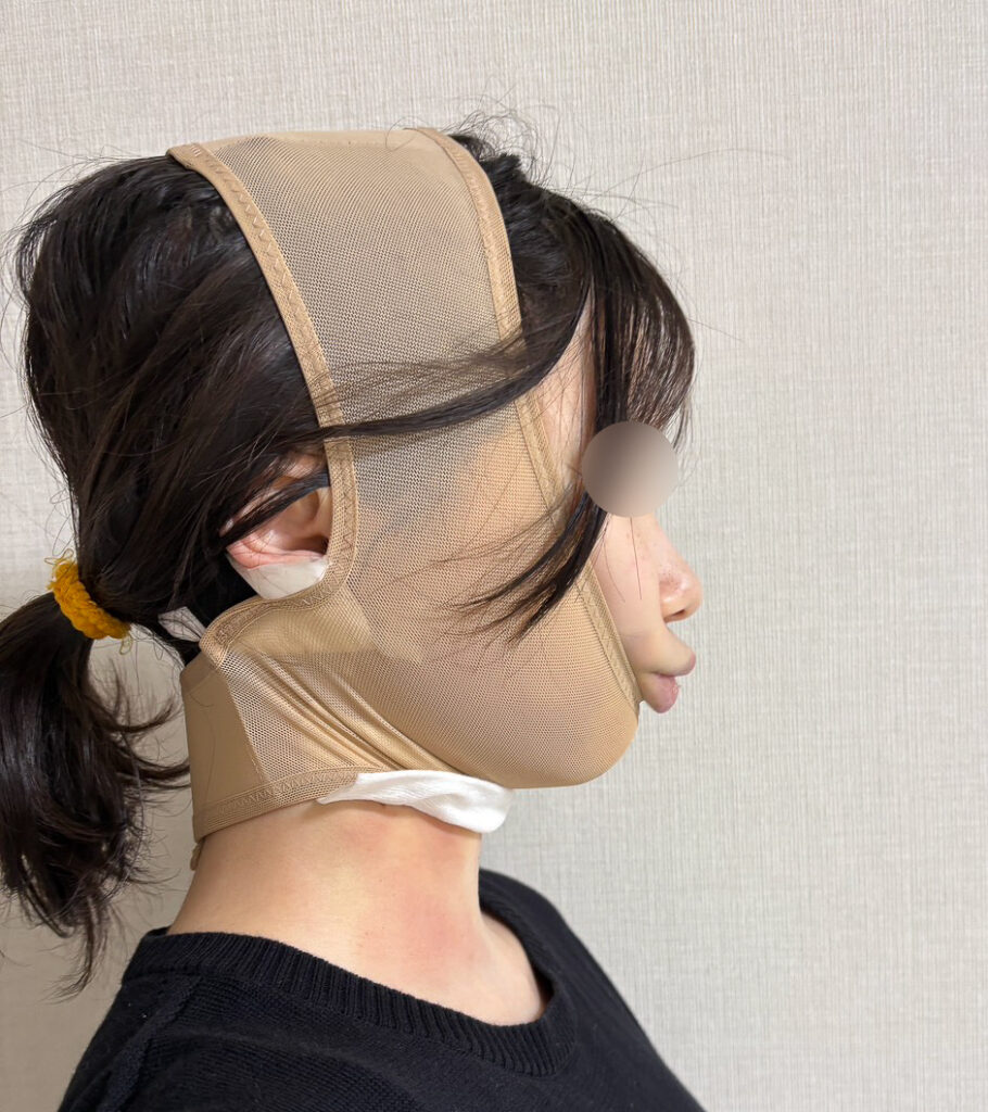 顔の脂肪吸引