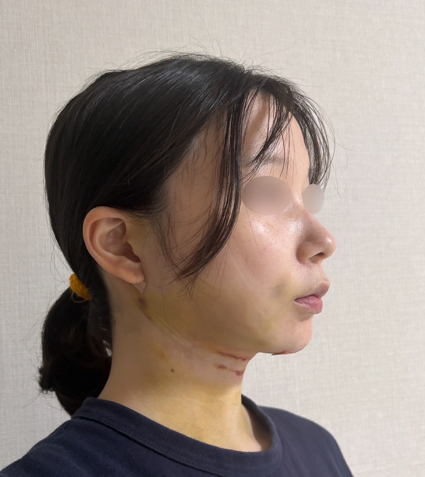 顔の脂肪吸引