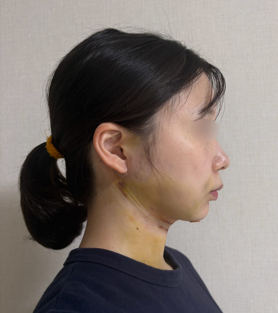 顔の脂肪吸引