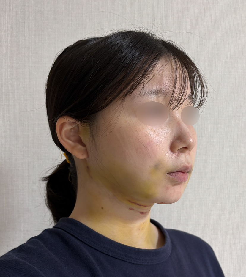 顔の脂肪吸引