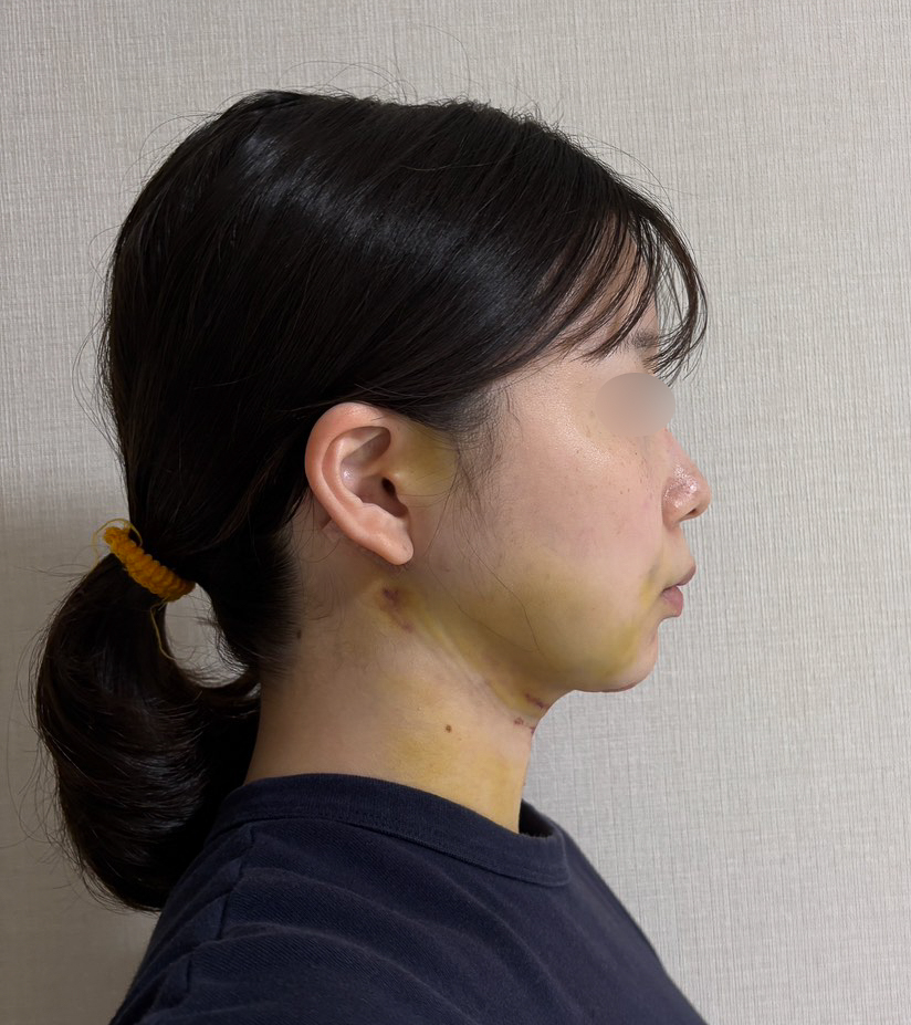 顔の脂肪吸引