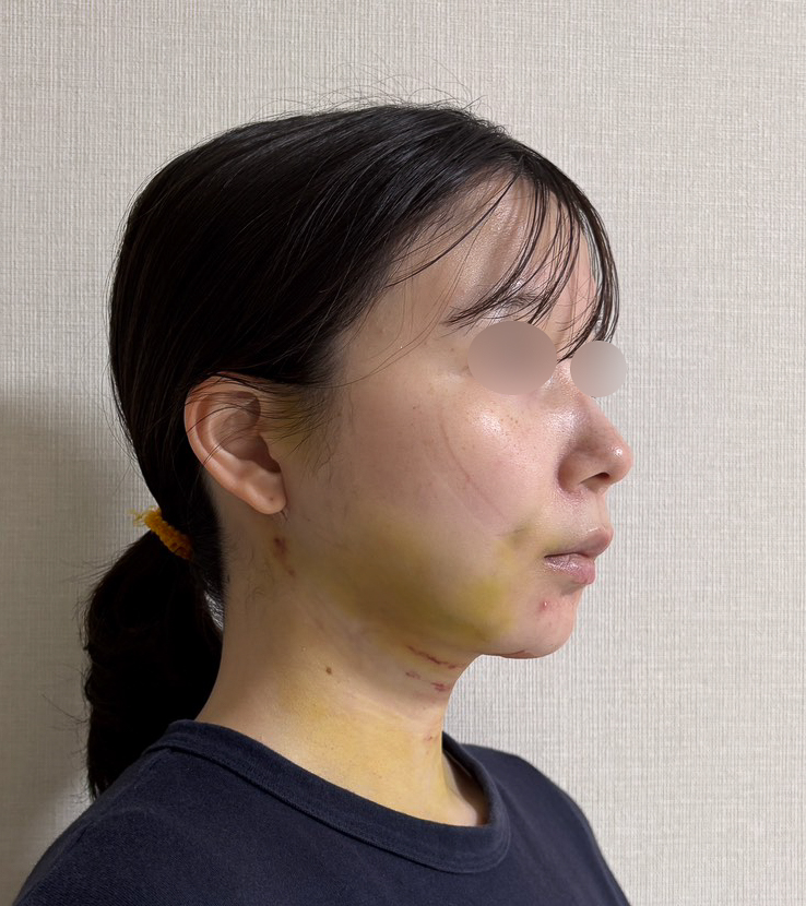 顔の脂肪吸引