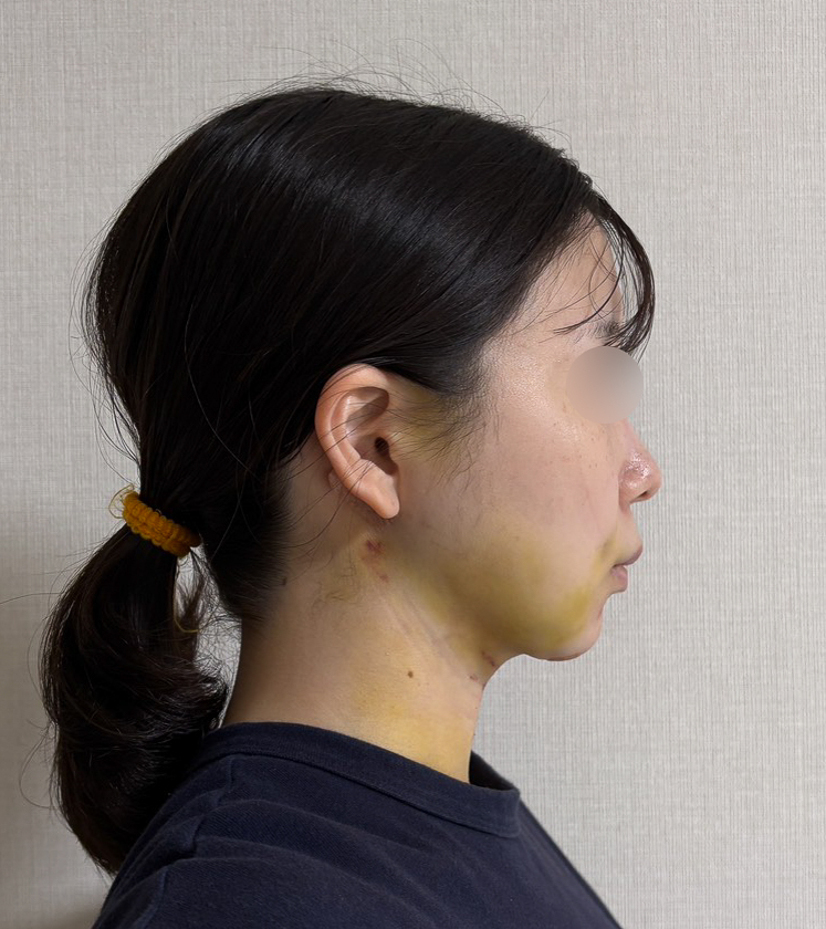 顔の脂肪吸引