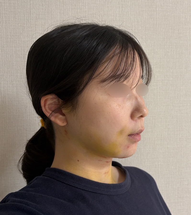 顔の脂肪吸引