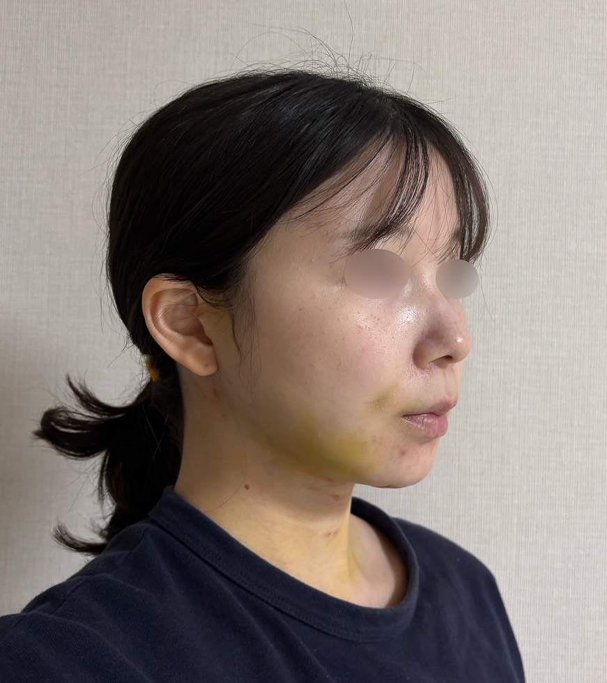 顔の脂肪吸引