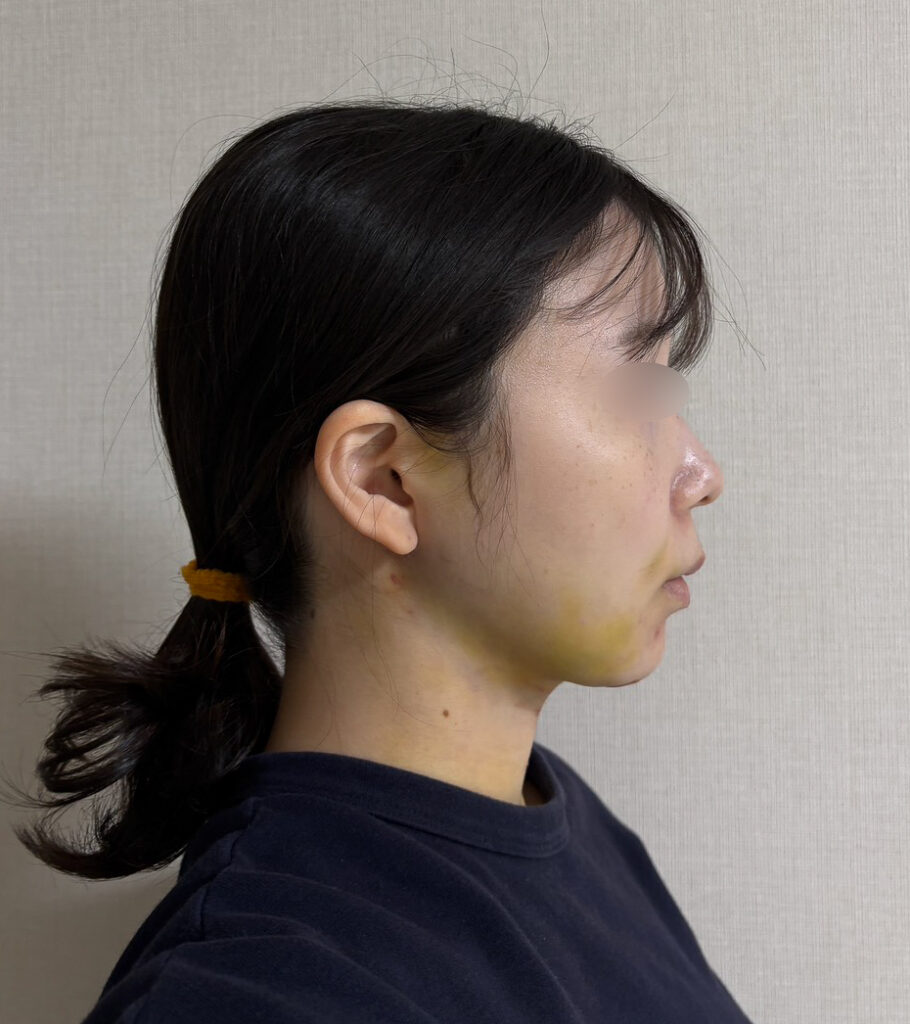 顔の脂肪吸引