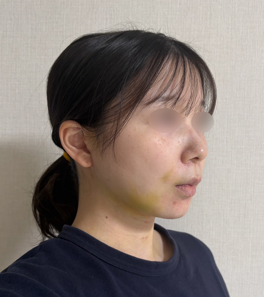 顔の脂肪吸引