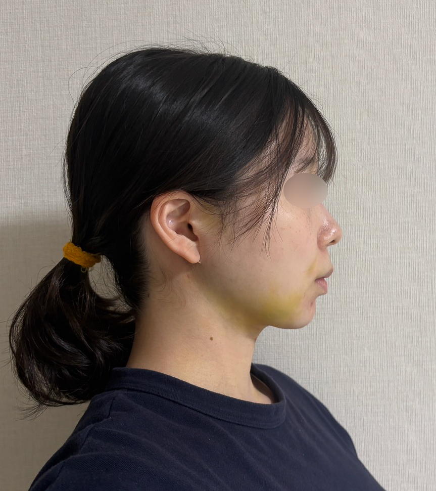 顔の脂肪吸引