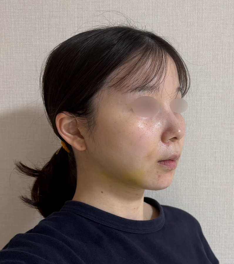 顔の脂肪吸引