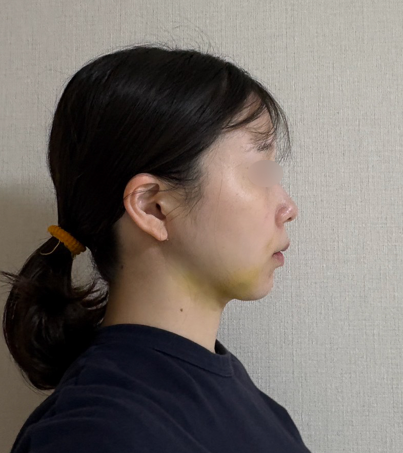 顔の脂肪吸引
