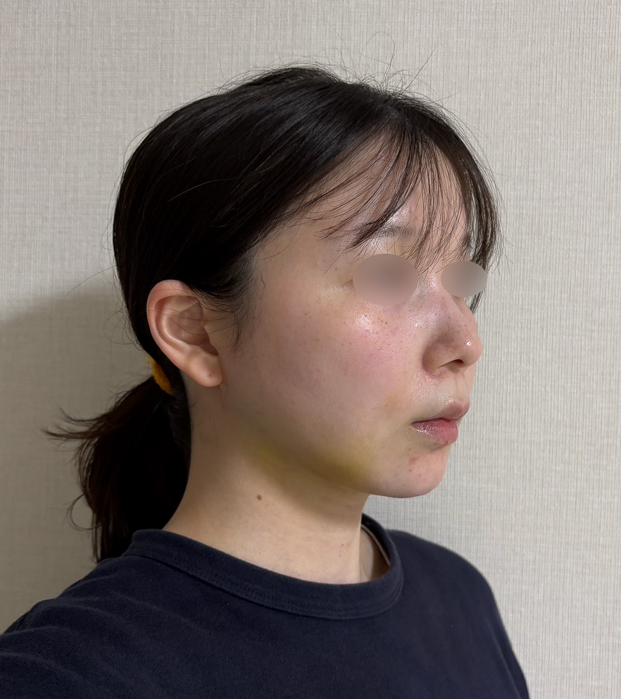 顔の脂肪吸引