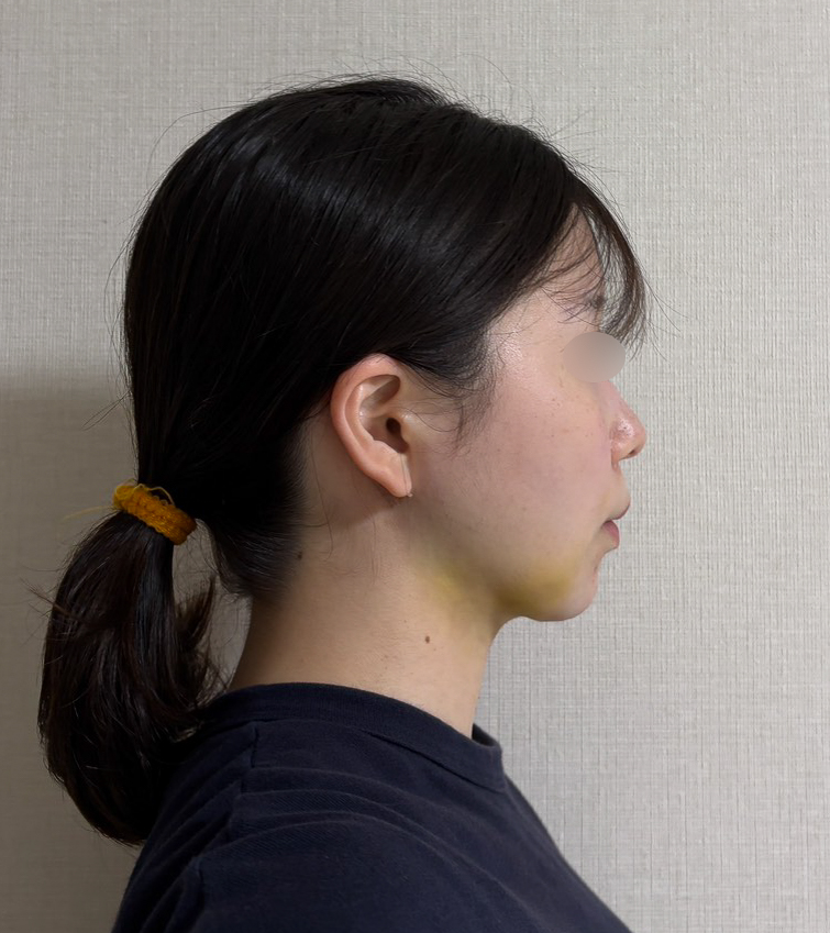 顔の脂肪吸引