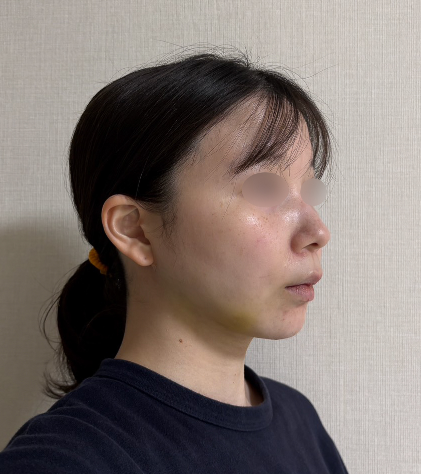 顔の脂肪吸引