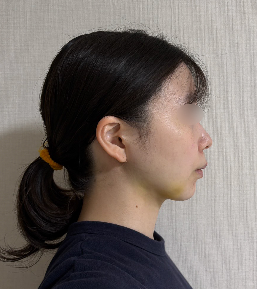 顔の脂肪吸引