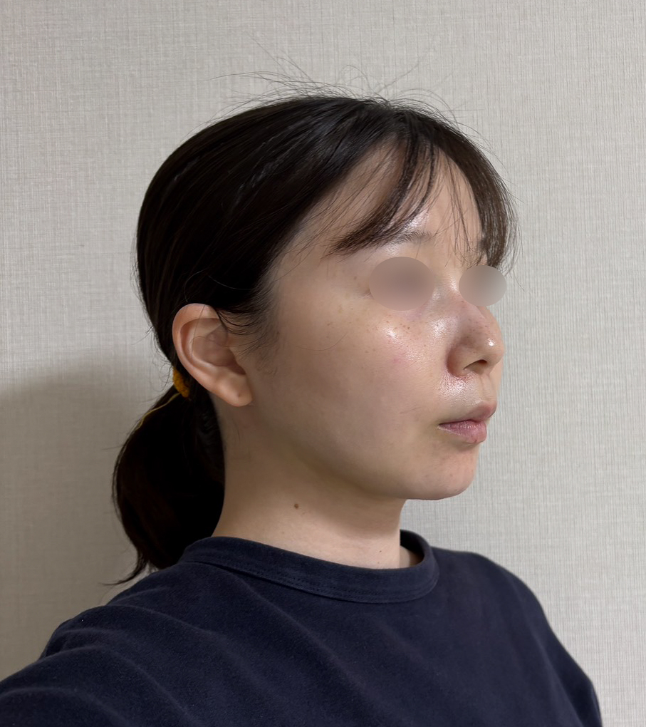 顔の脂肪吸引