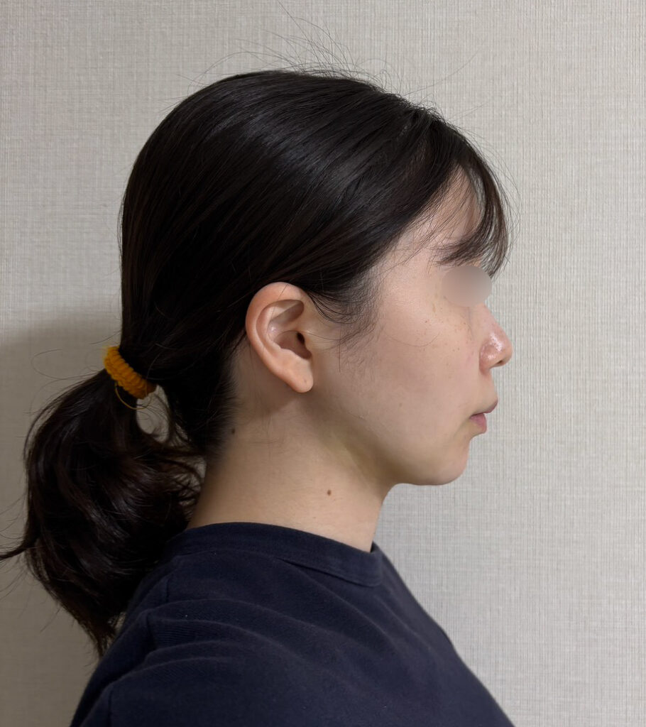 顔の脂肪吸引
