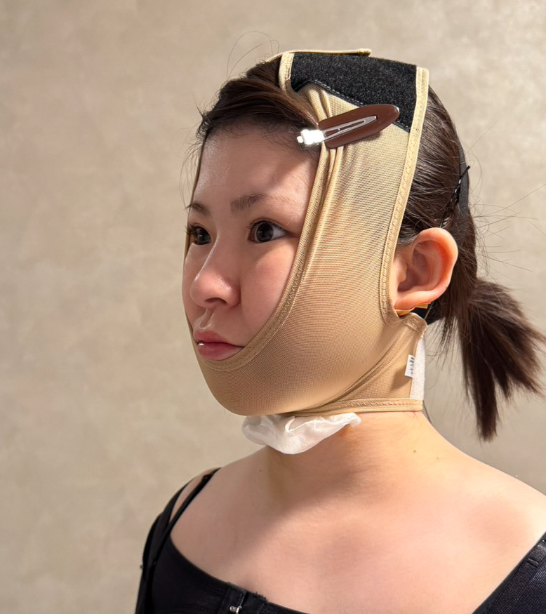 顔の脂肪吸引
