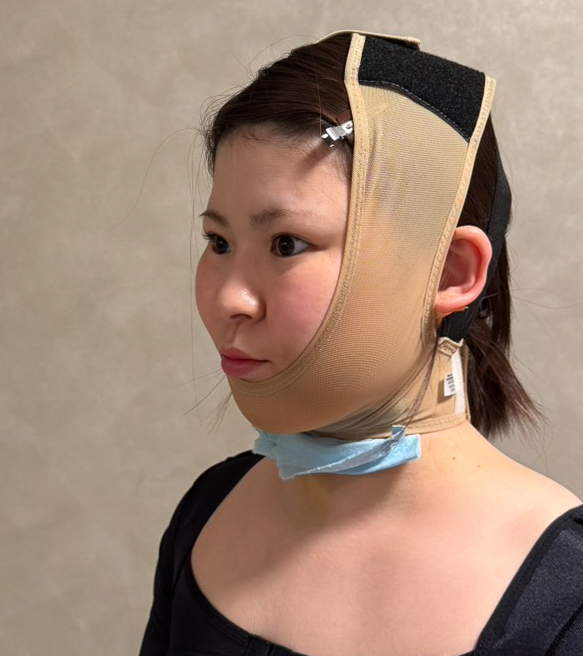 顔の脂肪吸引