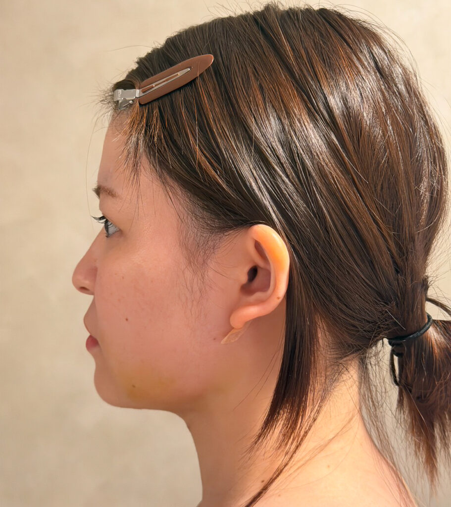 顔の脂肪吸引