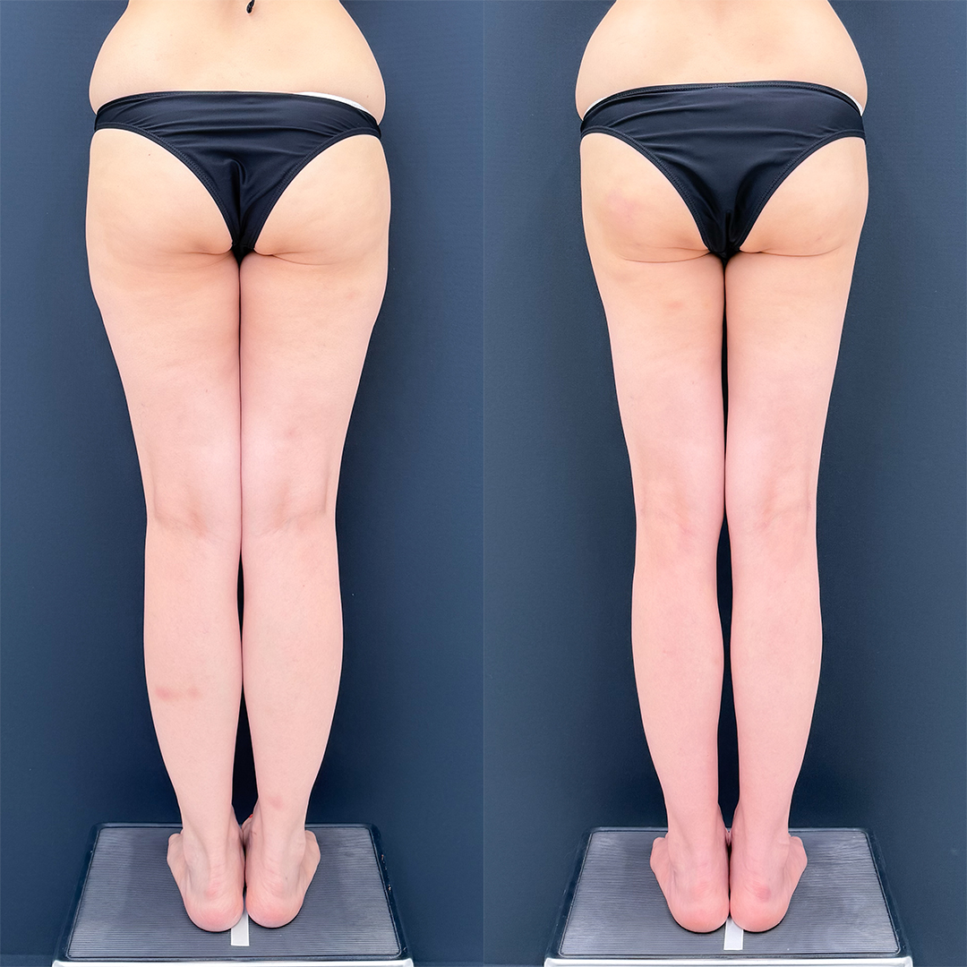 https://purelys-tokyo-clinic.com/wp/wp-content/uploads/2026/05/leg-Liposuction_Case-No.950.jpg