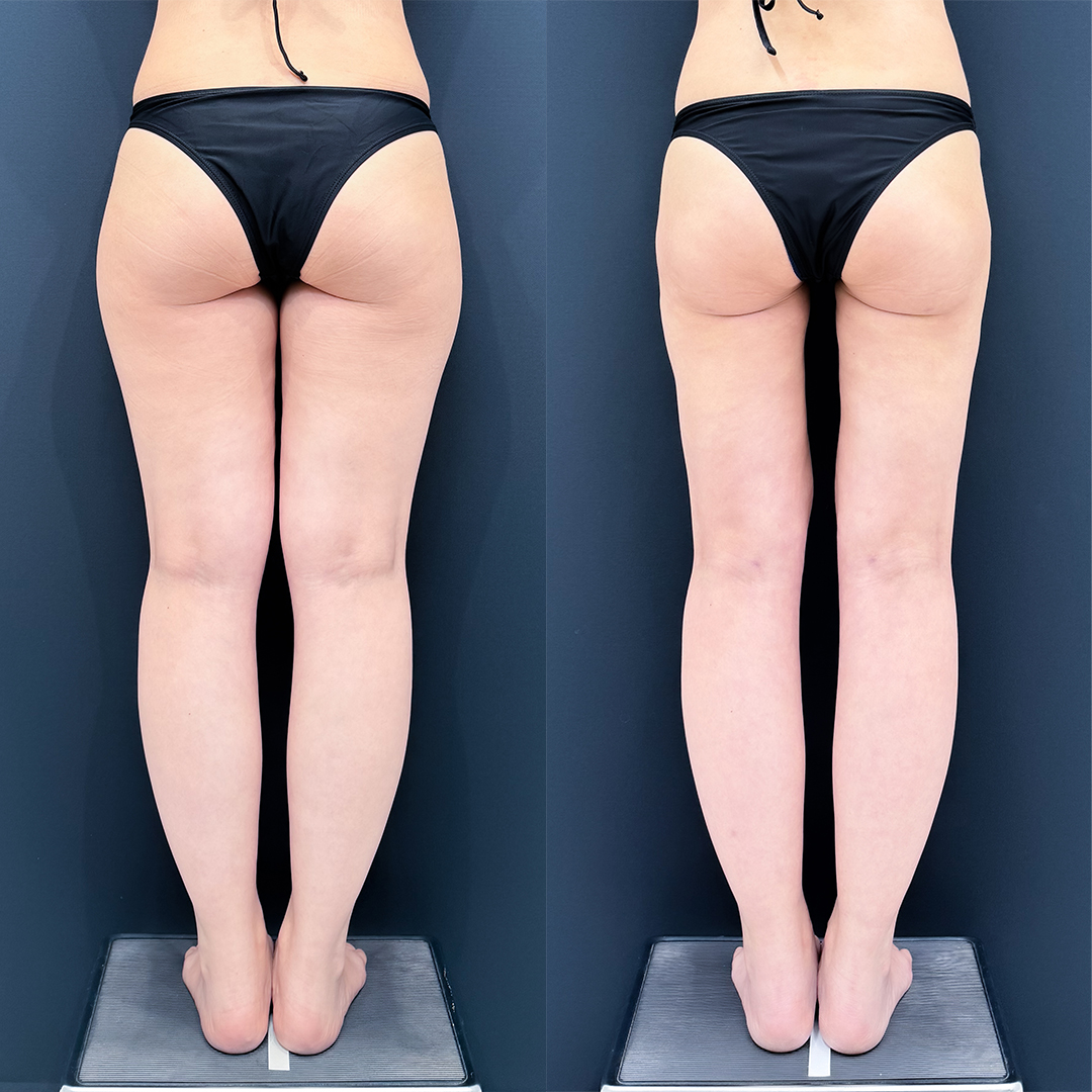 https://purelys-tokyo-clinic.com/wp/wp-content/uploads/2026/05/leg-Liposuction_Case-No.952.jpg