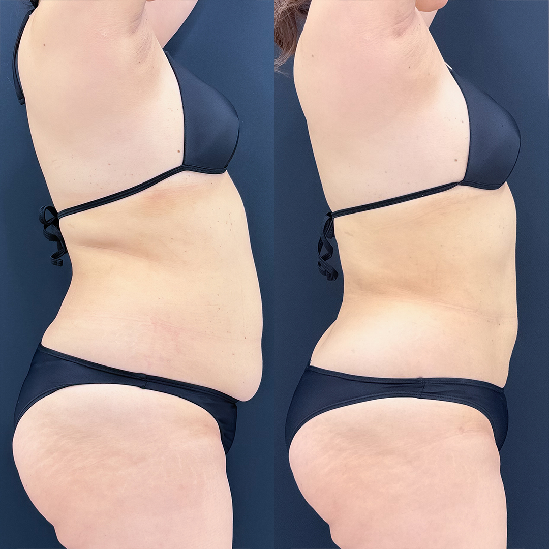 https://purelys-tokyo-clinic.com/wp/wp-content/uploads/2026/06/Before-and-After-abdominal-Liposuction_Case-No.494.jpg