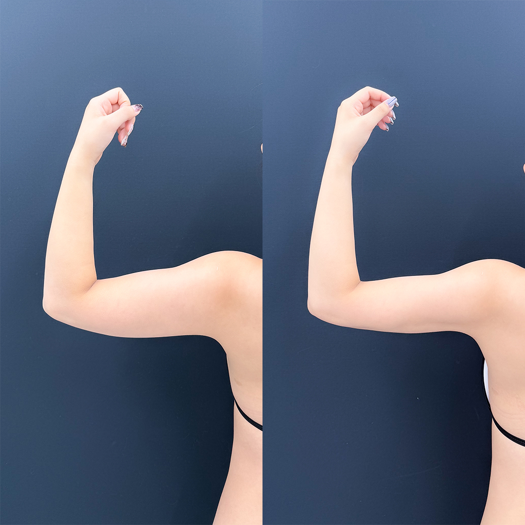 https://purelys-tokyo-clinic.com/wp/wp-content/uploads/2026/06/arm-Liposuction_Case-No.665.jpg