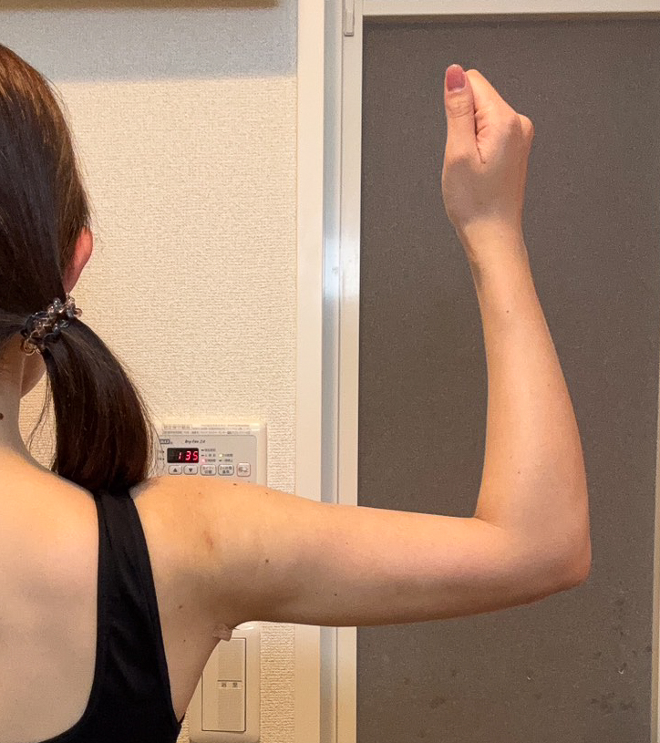二の腕の脂肪吸引