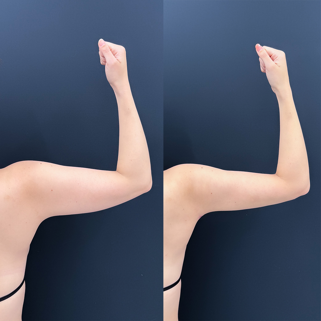 https://purelys-tokyo-clinic.com/wp/wp-content/uploads/2026/06/arm-Liposuction_Case-No.698.jpg