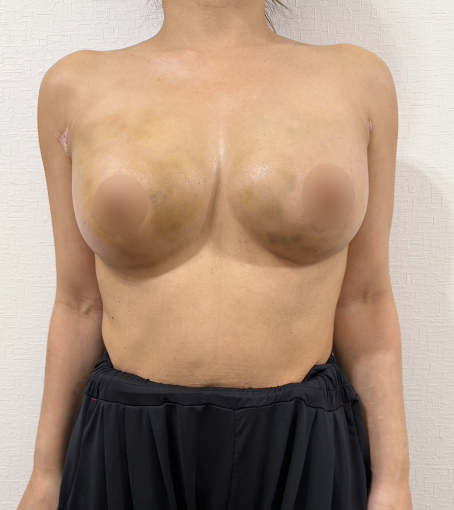 脂肪豊胸