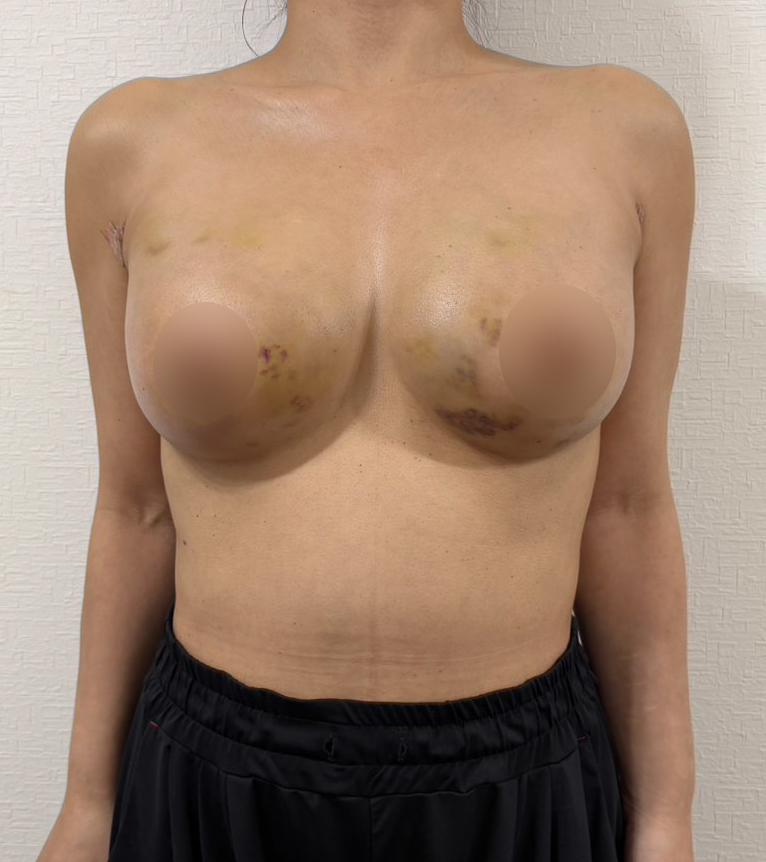 脂肪豊胸