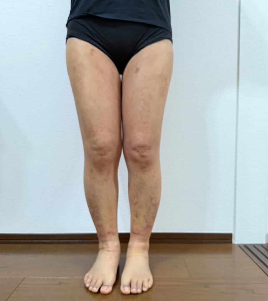 脂肪豊胸