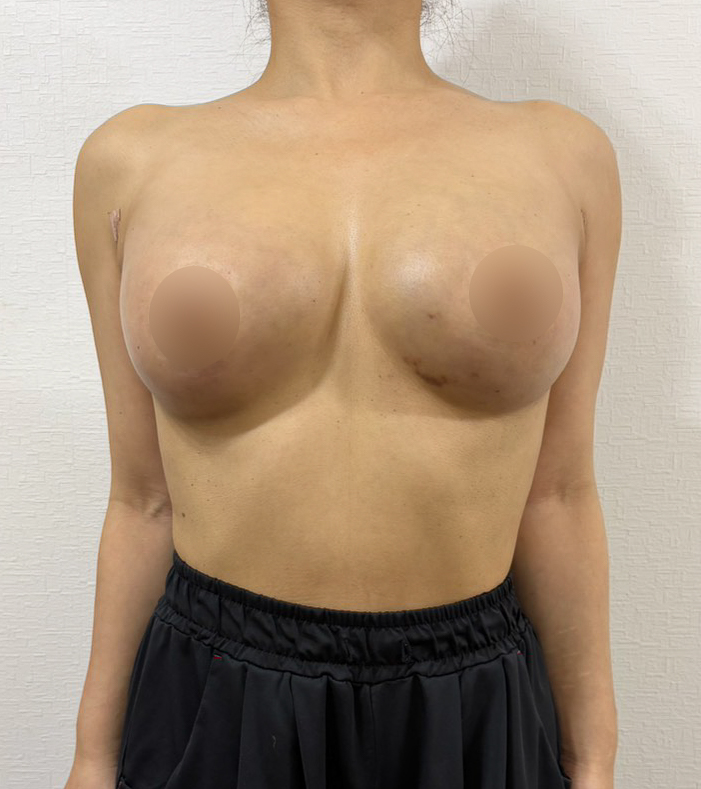 脂肪豊胸