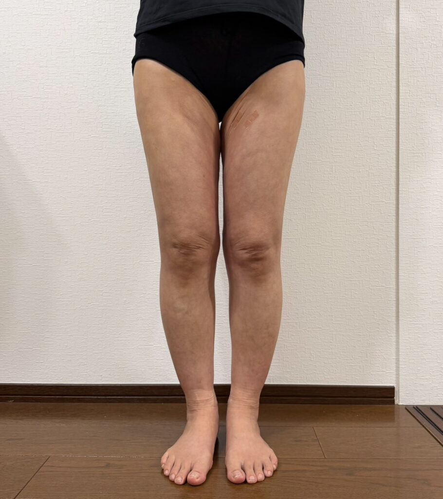 脂肪豊胸