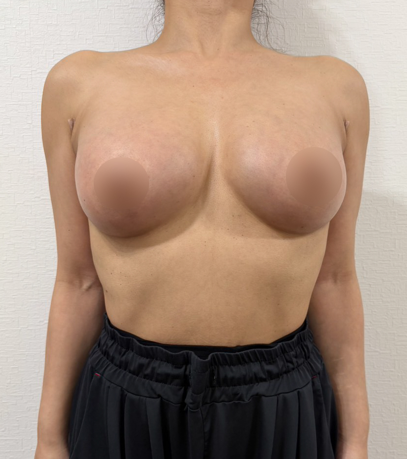脂肪豊胸